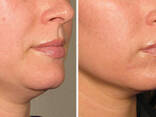 Контурная пластика лица и зоны декольте филлерами мезотерапия - фото 2